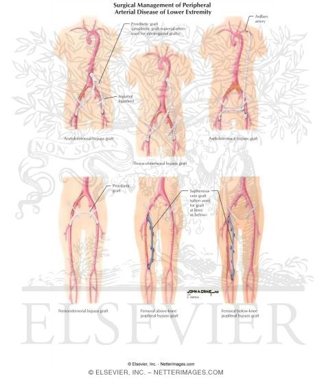 Surgical Management of Peripheral Arterial Disease of Lower Extremity