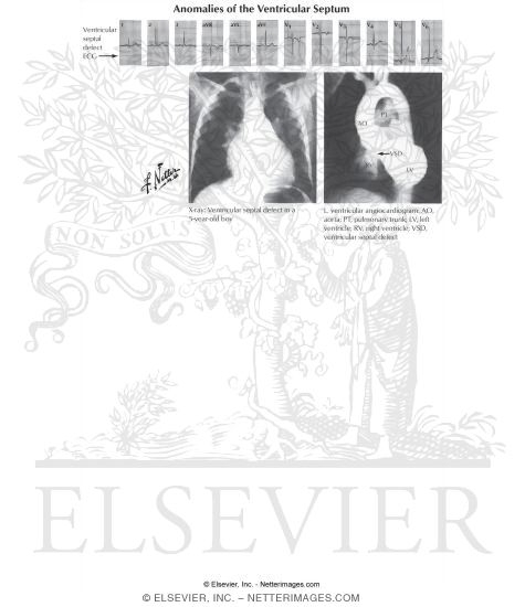 Anomalies of the Right Ventricular-Outflow Tract