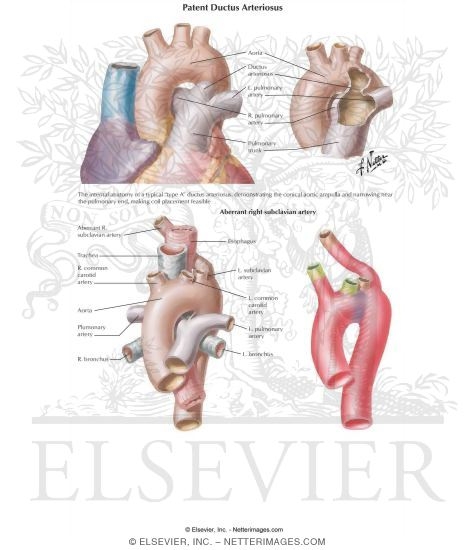 Patent Ductus Arteriosus