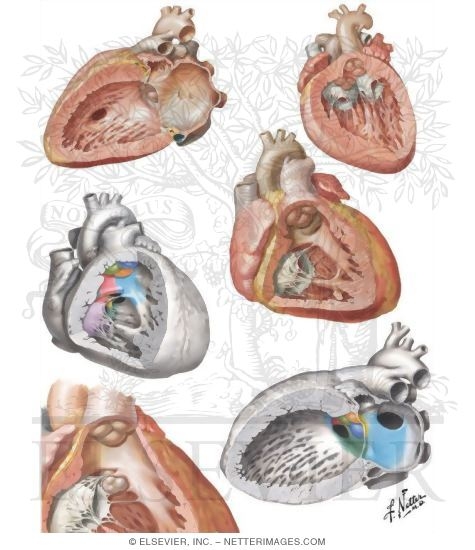 Anatomic Features of Perimembranous and Muscular Ventricular Septal Defects