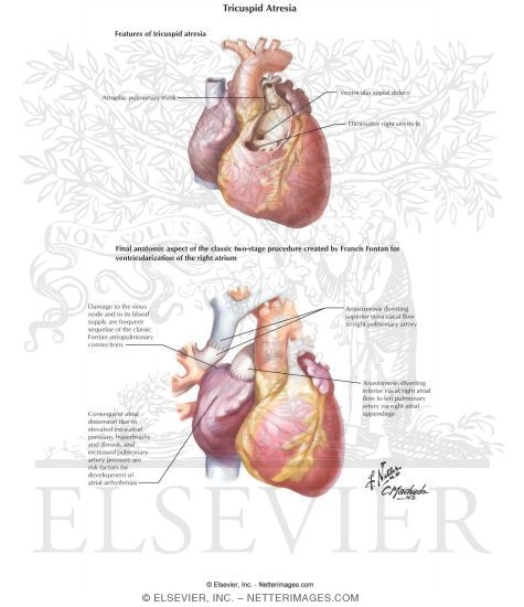 Tricuspid Atresia