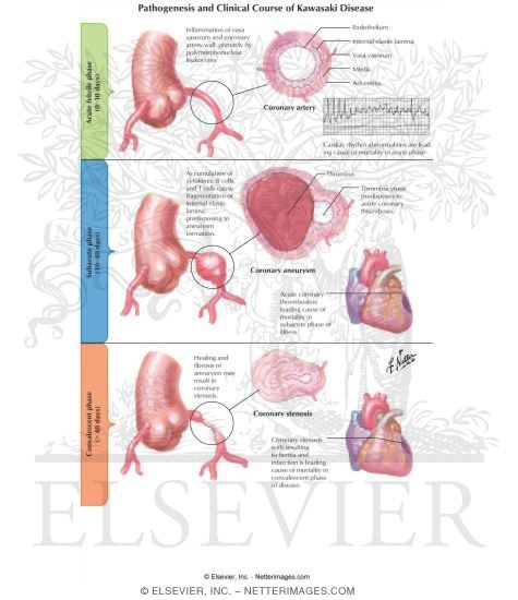 Pathogenesis and Clinical Course of Kawasaki Disease