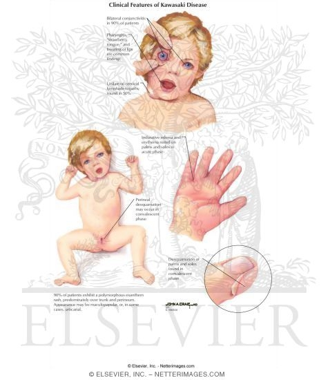 Clinical Features of Kawasaki Disease