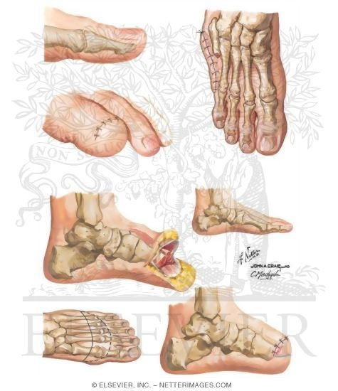 foot amputation pictures