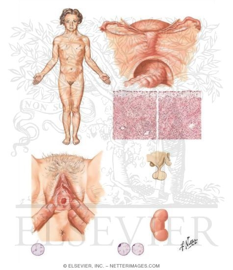 Syndrome of Gonadal Dysgenesis (Turner's Syndrome)