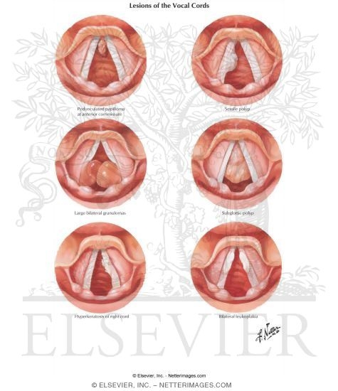 Lesions of the Vocal Cords