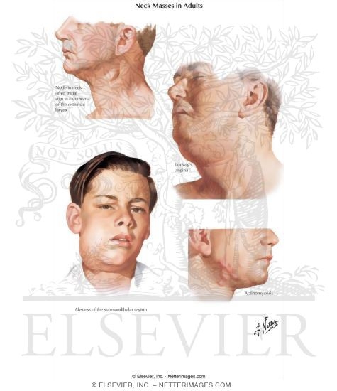 Neck Mass