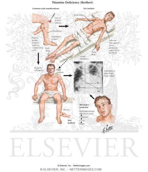 Thiamine Deficiency (Beriberi)