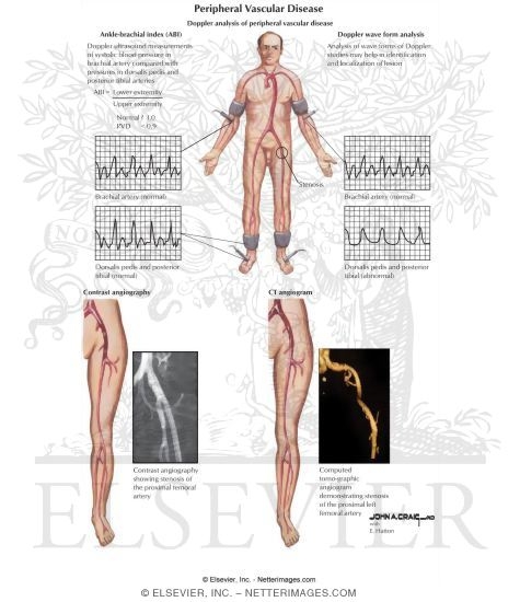 Peripheral Vascular Disease