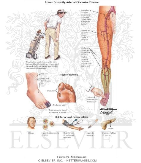 Lower Extremity Arterial Occlusive Disease