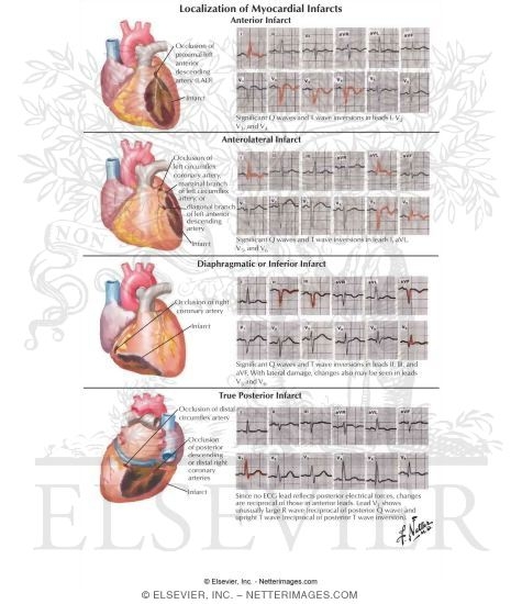 Localization of Myocardial Infarcts