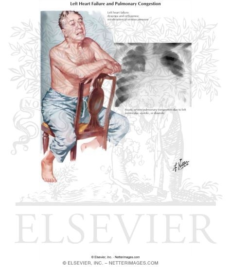 Left Heart Failure and Pulmonary Congestion