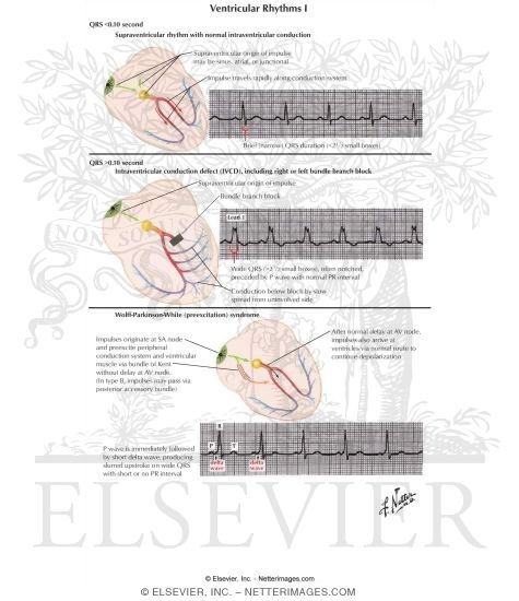 Ventricular Rythyms