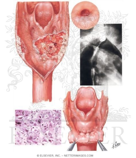 Malignant Tumors I - Upper Part of Esophagus