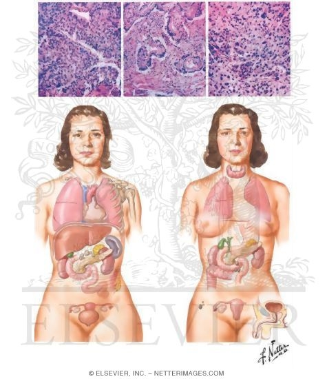 Malignant Tumors III - Histology, Metastases