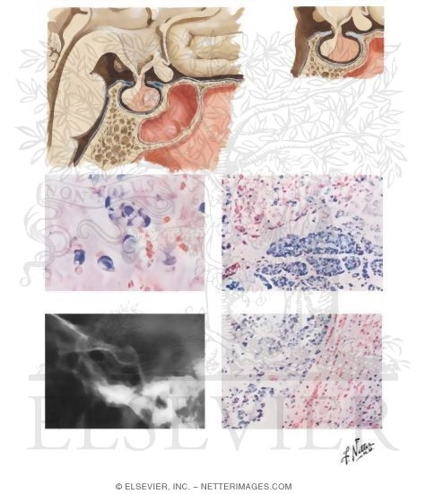 Corticotropin-Secreting Pituitary Tumor