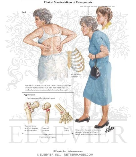Clinical Manifestations of Osteoporosis