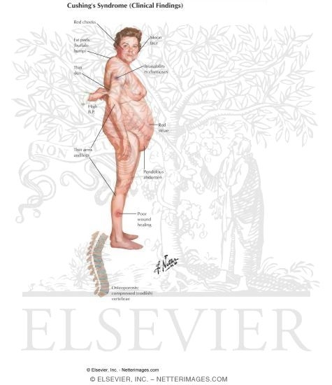 Cushing Disease