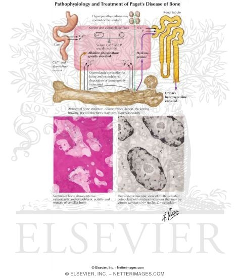 Pathophysiology and Treatment of Paget's Disease of Bone