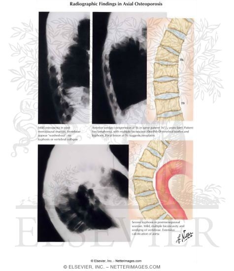 Radiographic Findings In Axial Osteoporosis