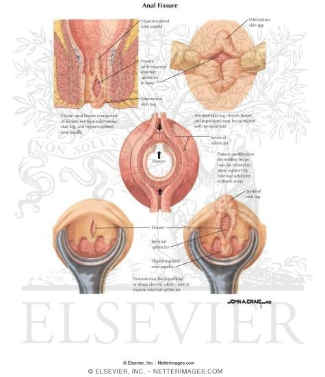 Anal Fissure Anal Fissure