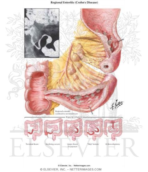 Regional Enteritis (Crohn Disease)
