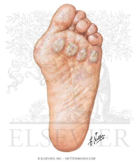 Foot Involvement in Rheumatoid Arthritis