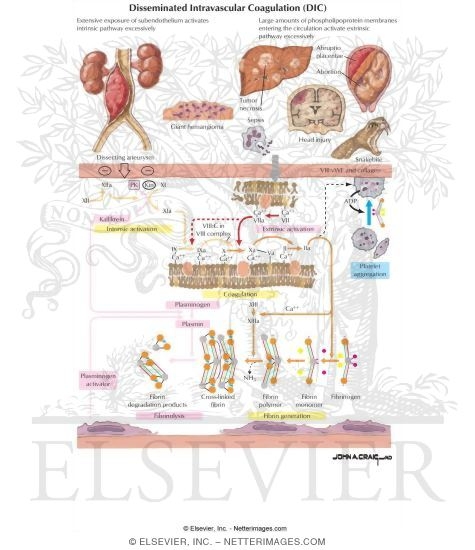 Disseminated Intravascular Coagulation (DIC)