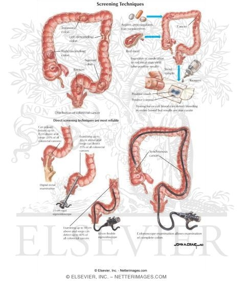 Colorectal Cancer: Screening Techniques