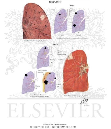 Lung Cancer
