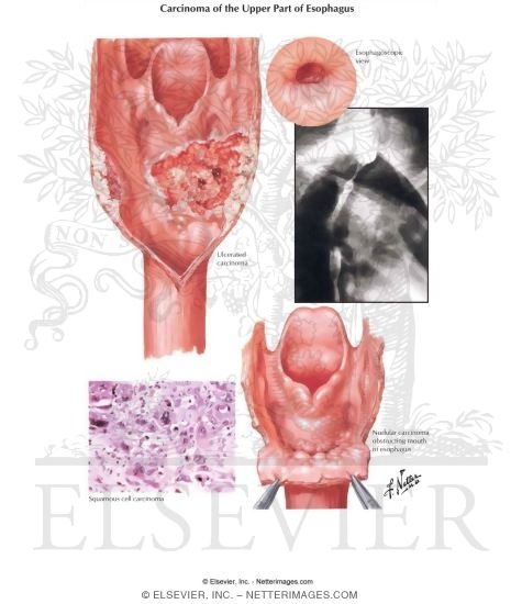 Malignant Tumors I - Upper Part of Esophagus