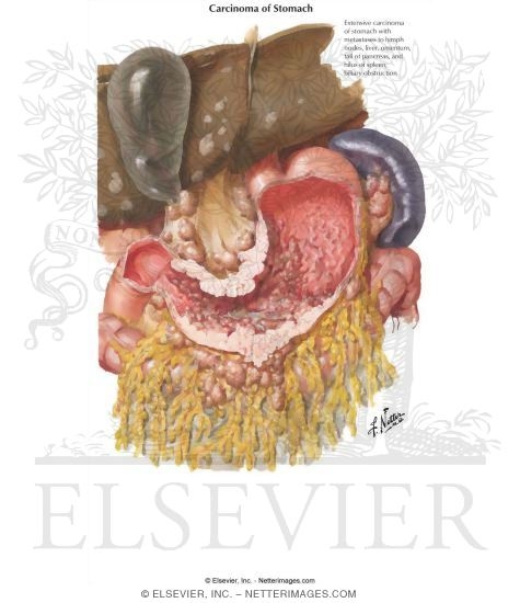 Spread of Carcinoma of Stomach