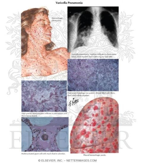Varicella Pneumonia