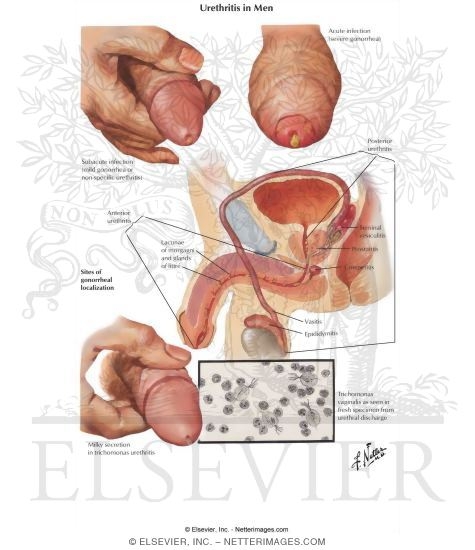 Urethritis In Men