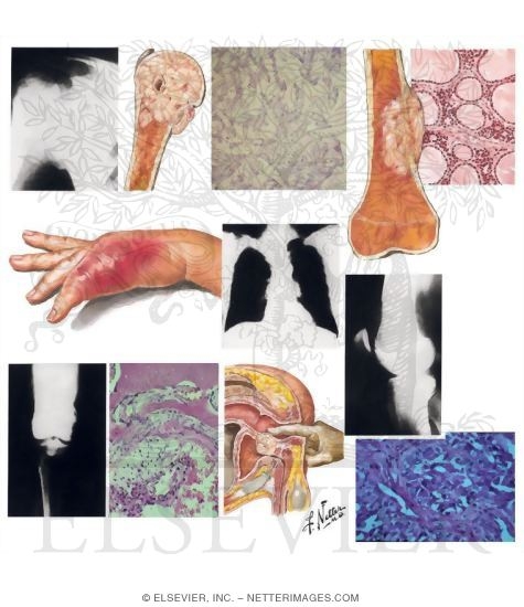 Tumors Metastatic to Bone