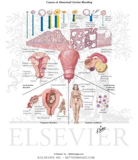 Dysfunctional Uterine Bleeding