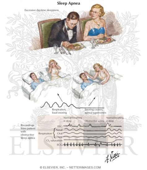 Obstructive Sleep Apnea