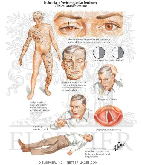 Stroke danger assessment atrial traumatic inflammation stroke prevention medicine united kingdom