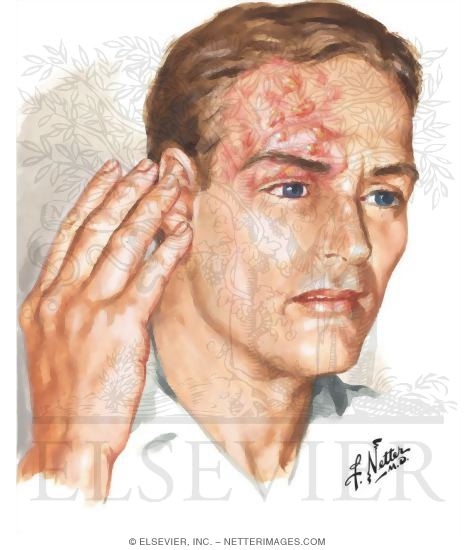 herpes zoster face. Herpes Zoster Cornea Repeated