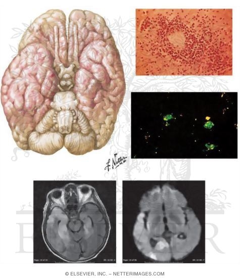 Herpes Simplex Encephalitis