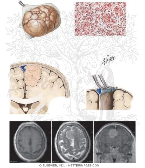 Meningiomas