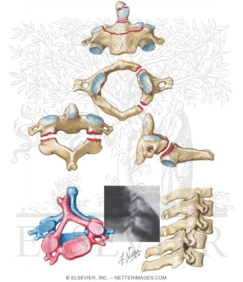 Fracture and Dislocation of Cervical Vertebrae