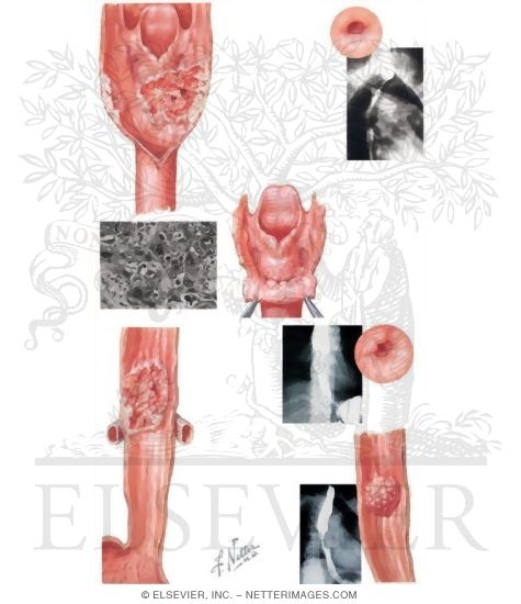 Malignant Tumors: Upper and Middle Portions of the Esophagus