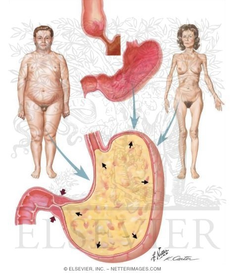Gastroparesis and Gastric