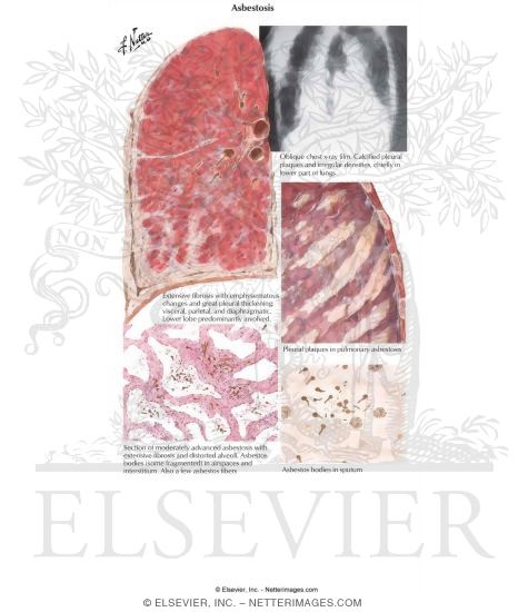 Asbestosis