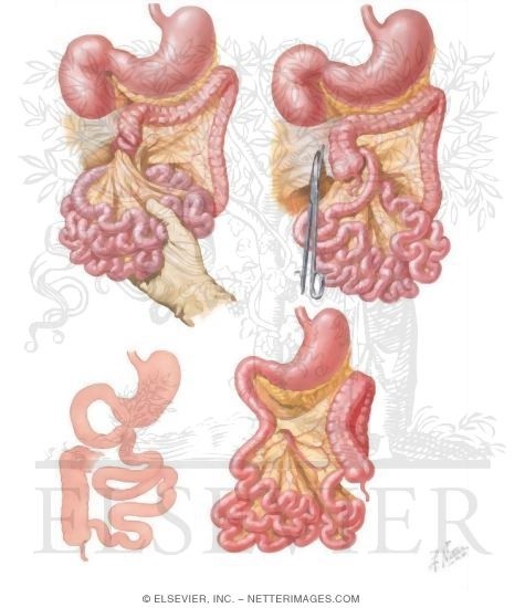 Congenital Intestinal Abnormalities, Including Malrotation of the Colon With Volvulus of the Midgut