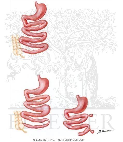 Bacterial Overgrowth Syndrome