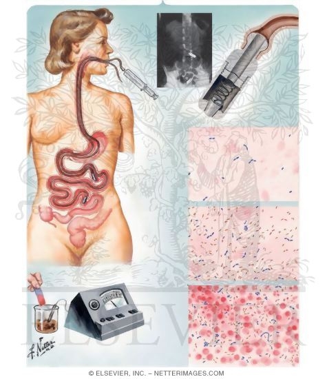 Intestinal Disturbances Resulting From Food Allergy