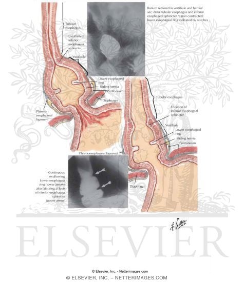 Inferior Esophageal Ring Formation