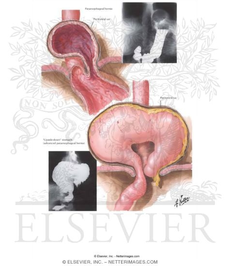 Thoracic Stomach II - Paracardial Hernia